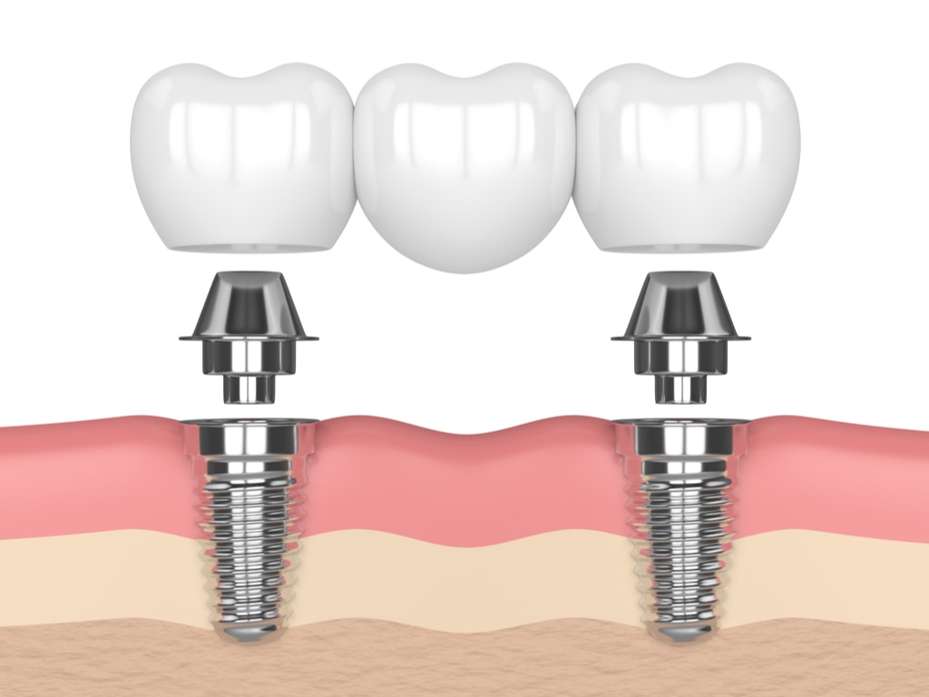 implantologie dentiste maarif casablanca